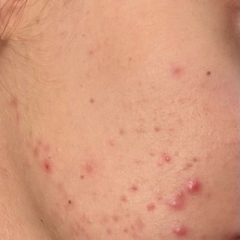 Sinoz Pink Sunscreen Ruined My Skin, Caused Severe Acne and Emotional Distress