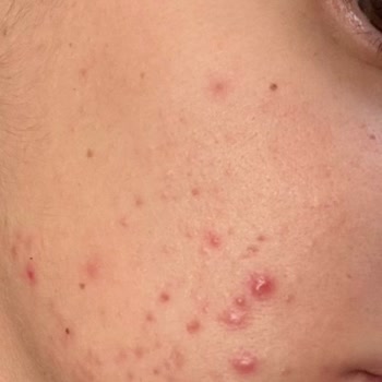 Sinoz Pink Sunscreen Ruined My Skin, Caused Severe Acne and Emotional Distress