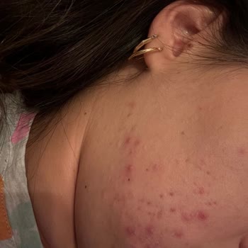 Sinoz Pink Sunscreen Ruined My Skin, Caused Severe Acne and Emotional Distress