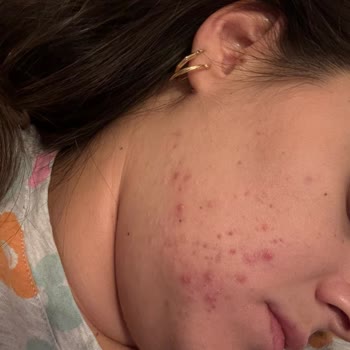 Sinoz Pink Sunscreen Ruined My Skin, Caused Severe Acne and Emotional Distress