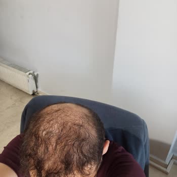 Saç Ekimi Hayal Kırıklığı: Orantısız Alım Ve Eksik Ekim Sorunu