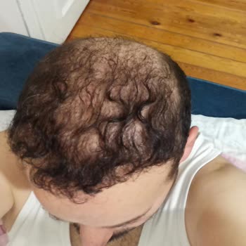 Saç Ekimi Hayal Kırıklığı: Orantısız Alım Ve Eksik Ekim Sorunu