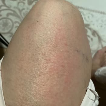 Bingo Toz Deterjan Alerji Ve Etkisizlik Sorunu