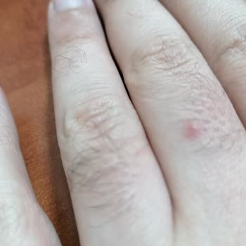 Sivrisineklerle Etkin Mücadele Eksikliği Uykusuz Bırakıyor