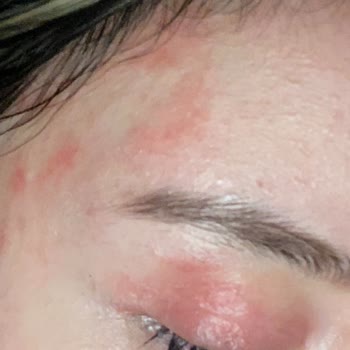 Nivea Makeup Remover from Gratis Caused Severe Irritation