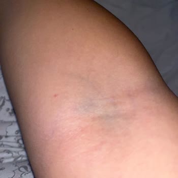 Damar Yolu Açma Sorunu Ve Hasta Memnuniyetsizliği