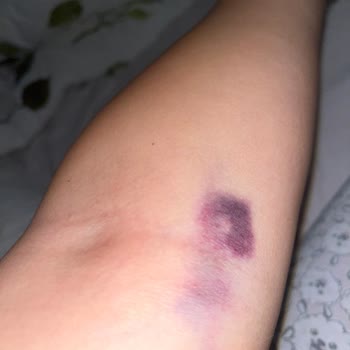 Damar Yolu Açma Sorunu Ve Hasta Memnuniyetsizliği