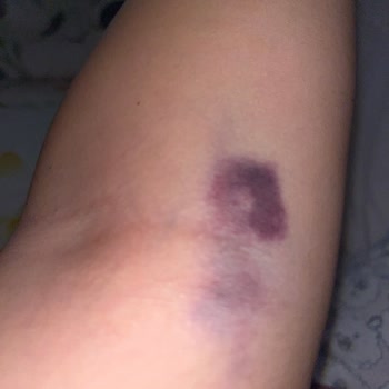 Damar Yolu Açma Sorunu Ve Hasta Memnuniyetsizliği