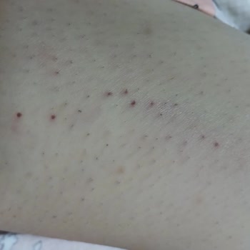 Lazer Epilasyon Sonuçsuz: Tüyler Daha Koyu Ve Gür
