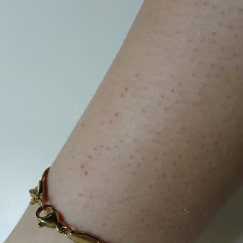 Lazer Epilasyon Sonuçsuz: Tüyler Daha Koyu Ve Gür