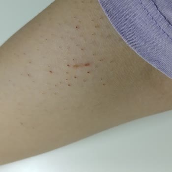 Lazer Epilasyon Sonuçsuz: Tüyler Daha Koyu Ve Gür