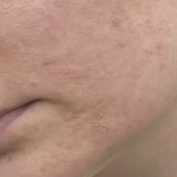 C Vitamini Ürünü Cildimi Yaktı Ve Sivilce Yaptı