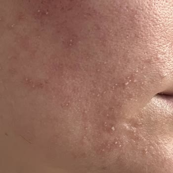 C Vitamini Ürünü Cildimi Yaktı Ve Sivilce Yaptı