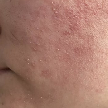 C Vitamini Ürünü Cildimi Yaktı Ve Sivilce Yaptı