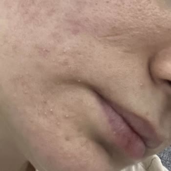 C Vitamini Ürünü Cildimi Yaktı Ve Sivilce Yaptı