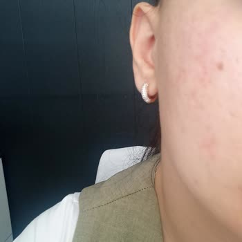 Alerji Yapan Ürünler Ve Yanlış Güven