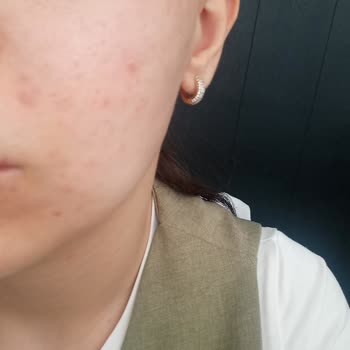 Alerji Yapan Ürünler Ve Yanlış Güven