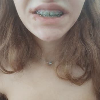 Diş Teli Tedavisinde Yaşanan Sorunlar Ve Kötü Muamele