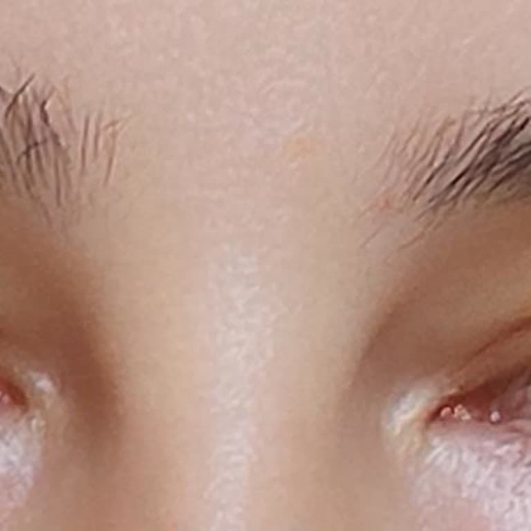 Botoks Sonrası Göz Kapağı Problemi Ve Çaresizlik