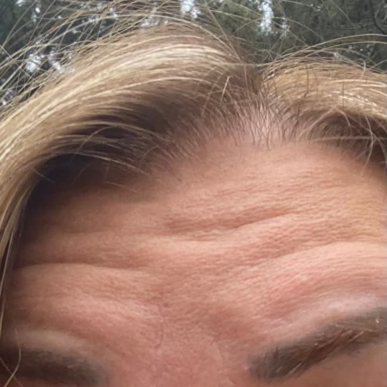 Botoks Uygulamasında Hayal Kırıklığı