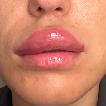 Magnet Hastanesi Yanlış Uygulama Ve Kötü Deneyim: Dolgu Ve Botox Kabusu!