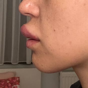 Magnet Hastanesi Yanlış Uygulama Ve Kötü Deneyim: Dolgu Ve Botox Kabusu!