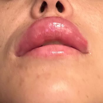 Magnet Hastanesi Yanlış Uygulama Ve Kötü Deneyim: Dolgu Ve Botox Kabusu!