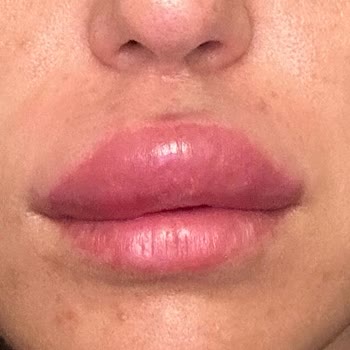 Magnet Hastanesi Yanlış Uygulama Ve Kötü Deneyim: Dolgu Ve Botox Kabusu!