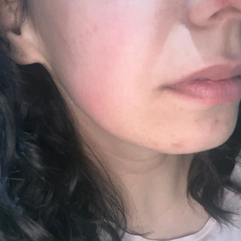 Duaderm Krem Yüzümde Kızarıklık Ve Kaşıntı Yaptı