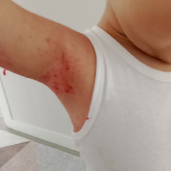 H&M Dark Polars Stained My Child’s Skin After Washing – Denied Return Due to Washing