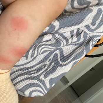 Sivrisineklerle Dolu Otelde Kabus Gibi Bir Gece