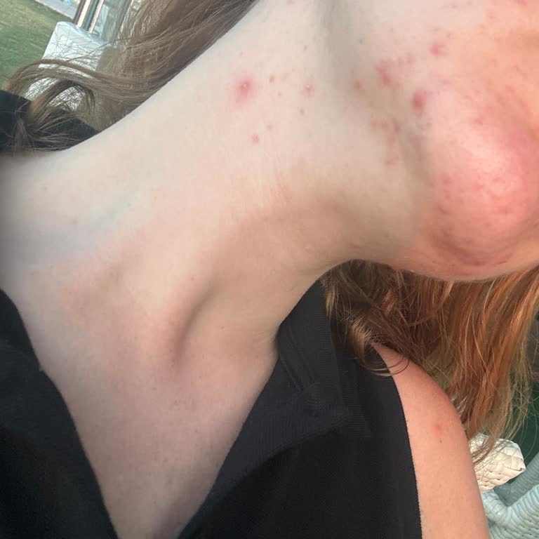 Nivea 50 SPF Moisturizing Sunscreen Caused Severe Breakouts