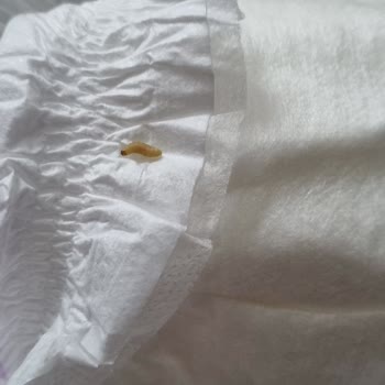 Bebek Bezinde Kurt Şoku