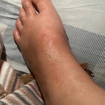 Ayak Maskesi Kabusu: Cilt Tahrişi Ve Kaşıntı