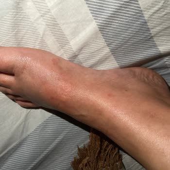 Ayak Maskesi Kabusu: Cilt Tahrişi Ve Kaşıntı