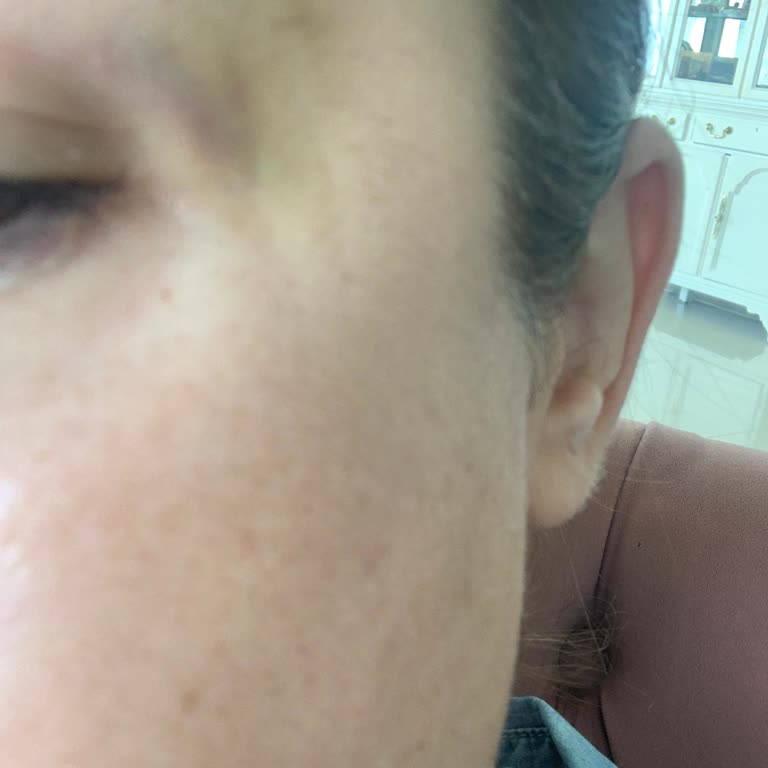 Bellapais Güzellik Merkezi Botox Sonrası Beklenmedik Göz Kapağı Sorunu