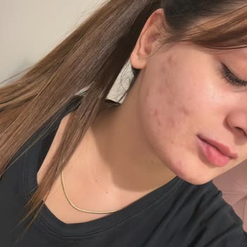 Pure Menthe Yüz Yıkama Jeli Sivilce Sorunu