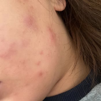 Pure Menthe Yüz Yıkama Jeli Sivilce Sorunu