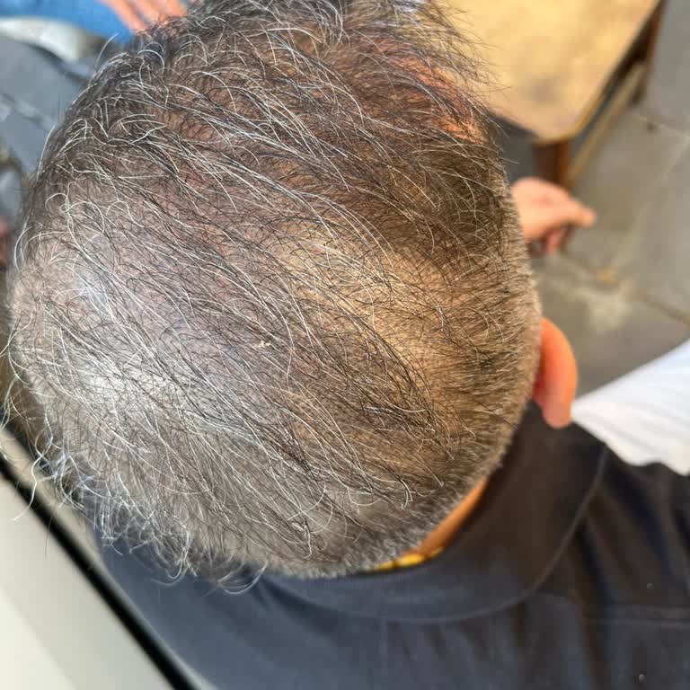 His Hair Center'da Kalıcı Sonuçsuz İşlem Deneyimi!