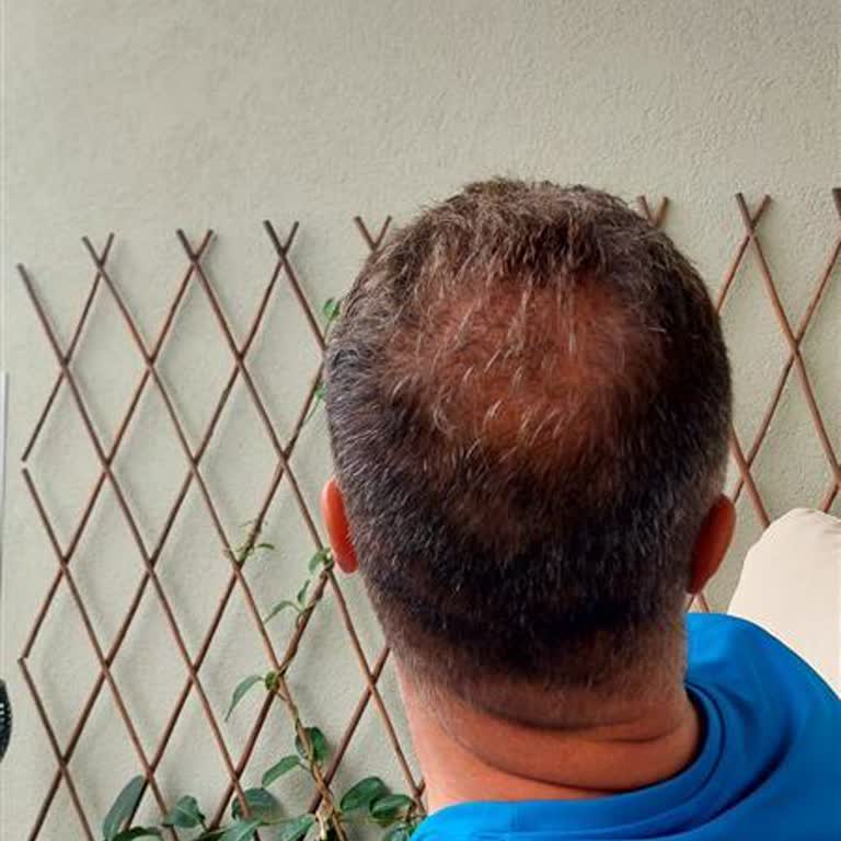 Starmed Saç Ekimi Deneyiminde Hayal Kırıklığı