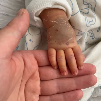 Bebek Kan Alımında Yetersiz Hemşirelik Hizmeti