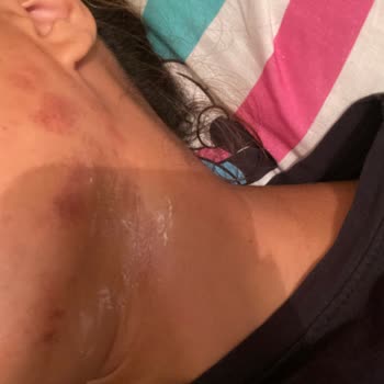 Özel Medifema Hastanesi'nde Epilasyon Kabusu