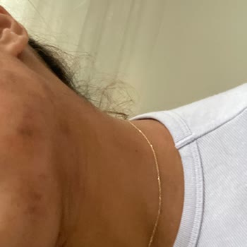 Özel Medifema Hastanesi'nde Epilasyon Kabusu