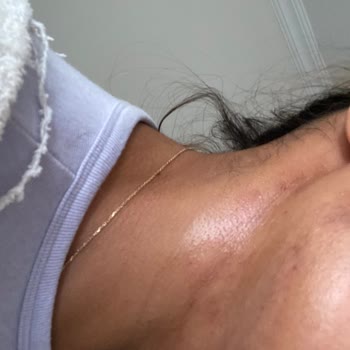 Özel Medifema Hastanesi'nde Epilasyon Kabusu