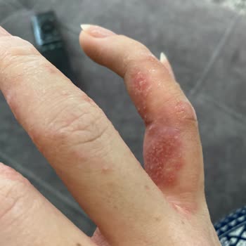 Egzama Kremi Mağduriyeti: Yanma Ve Su Toplaması