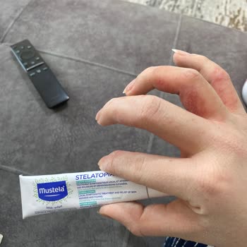 Egzama Kremi Mağduriyeti: Yanma Ve Su Toplaması