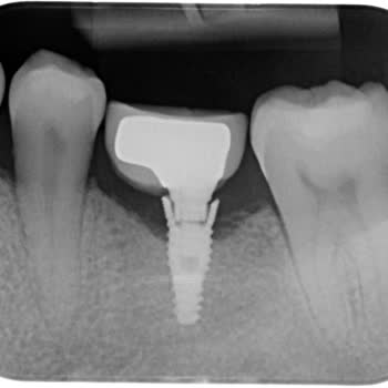 Garantili İmplant Mağduriyeti