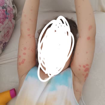 Klamoks Şurubun Ciddi Alerjik Reaksiyonu: Çocuğumun Sağlığı Tehlikede!