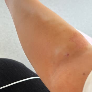 Yanlış Tedavi Sonrası Hastanede Zorunlu Yatış