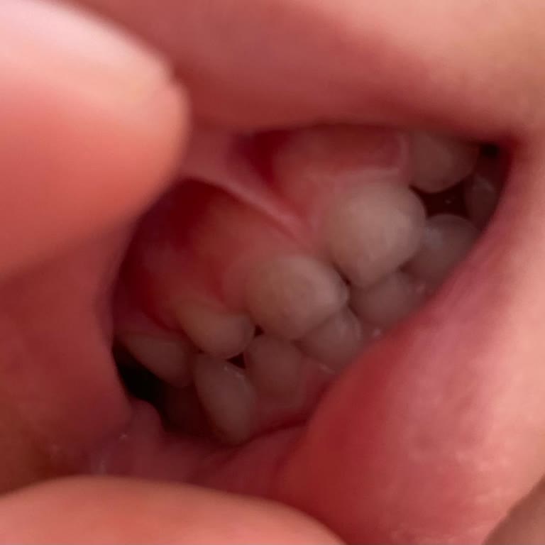 Orzax İlaç Demir Takviyesi Bebek Dişlerini Kararttı